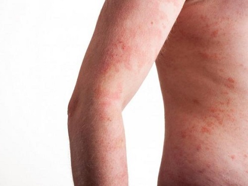 Los ungüentos las cremas de la psoriasis para la cabeza